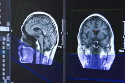 頭部MRI･MRA検査